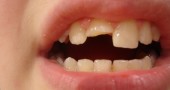 Trauma dentale bambino