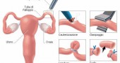legatura tube