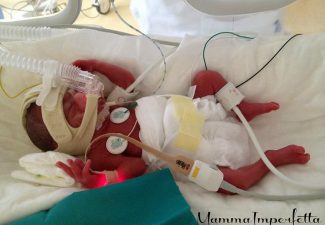 Displasia broncopolmonare del neonato