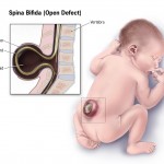 Spina-bifida