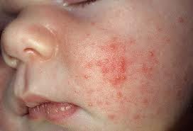 acne neonatale: puntini sul viso del bambino