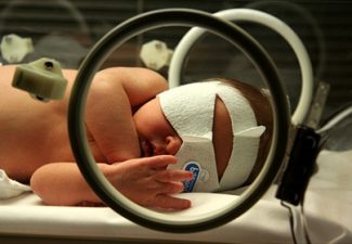 ittero neonato fototerapia